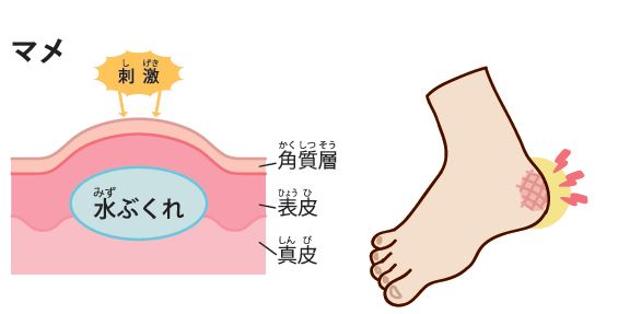 手にできる「タコ」と「マメ」の違いは? 【疑問氷解】