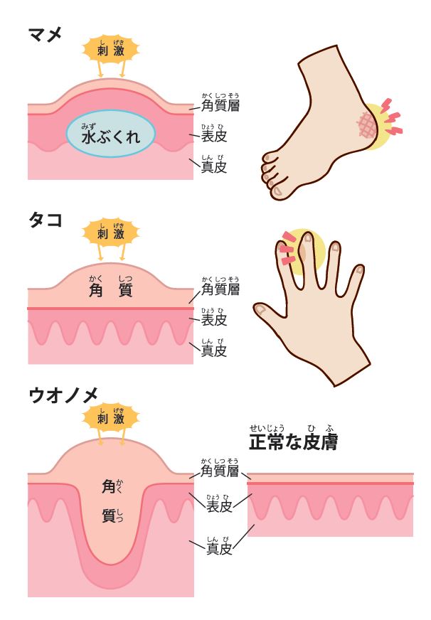 手にできる「タコ」と「マメ」の違いは? 【疑問氷解】 手にできる「タコ」と「マメ」の違いは? 【疑問氷解】